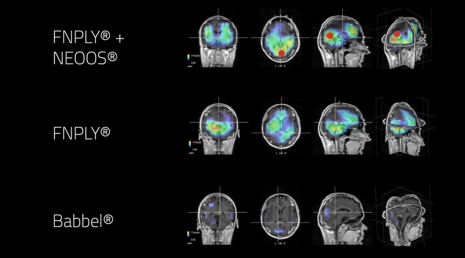 Gehirnscan zeigt verschiedene Gehirnaktivität wenn man mit Babbel oder den Birkenbihl-Sprachkursen von KOSYS lernt